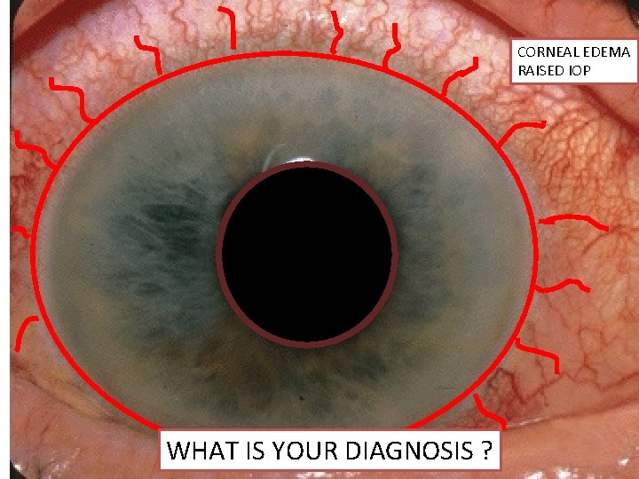 CORNEAL EDEMA RAISED IOP WHAT IS YOUR DIAGNOSIS ? 