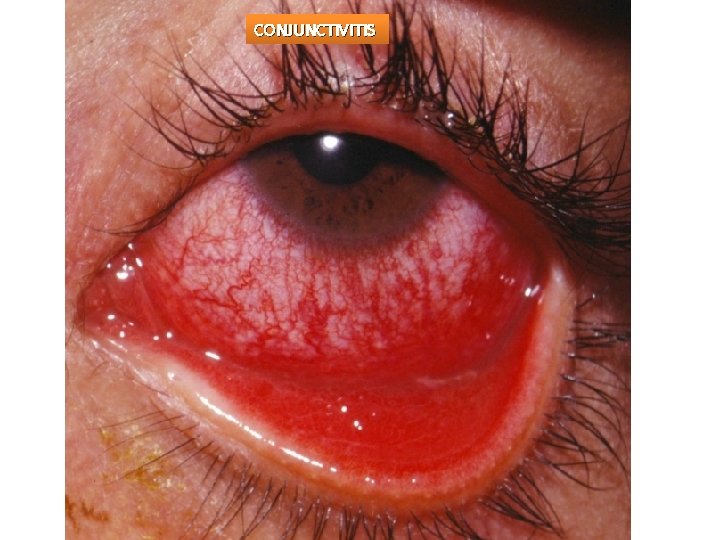 CONJUNCTIVITIS 