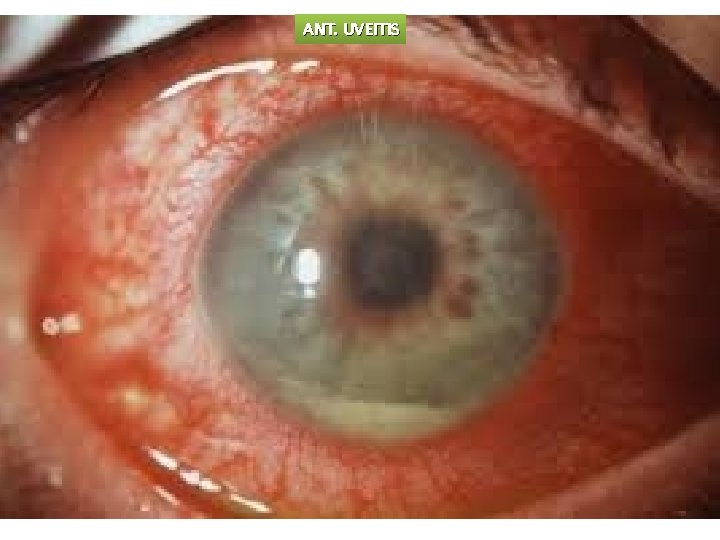 ANT. UVEITIS 