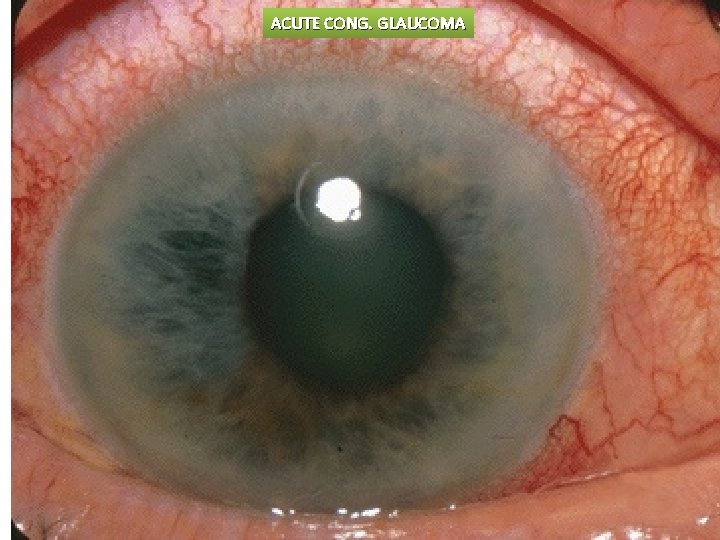 ACUTE CONG. GLAUCOMA 