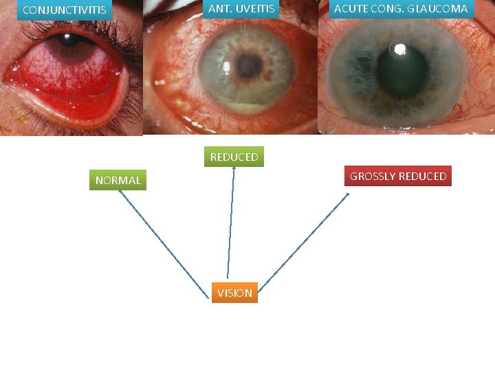 CONJUNCTIVITIS ANT. UVEITIS ACUTE CONG. GLAUCOMA REDUCED GROSSLY REDUCED NORMAL VISION 