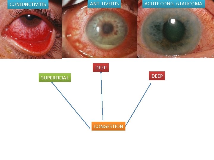 CONJUNCTIVITIS ANT. UVEITIS ACUTE CONG. GLAUCOMA DEEP SUPERFICIAL CONGESTION 