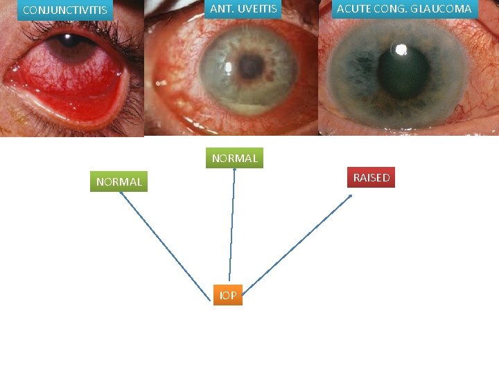 CONJUNCTIVITIS ANT. UVEITIS ACUTE CONG. GLAUCOMA NORMAL RAISED NORMAL IOP 