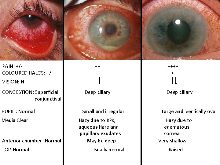 PAIN: +/COLOURED HALOS: +/- ++++ + VISION: N CONGESTION: Superficial conjunctival PUPIL : Normal