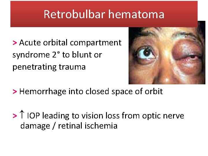 Retrobulbar hematoma > Acute orbital compartment syndrome 2° to blunt or penetrating trauma >