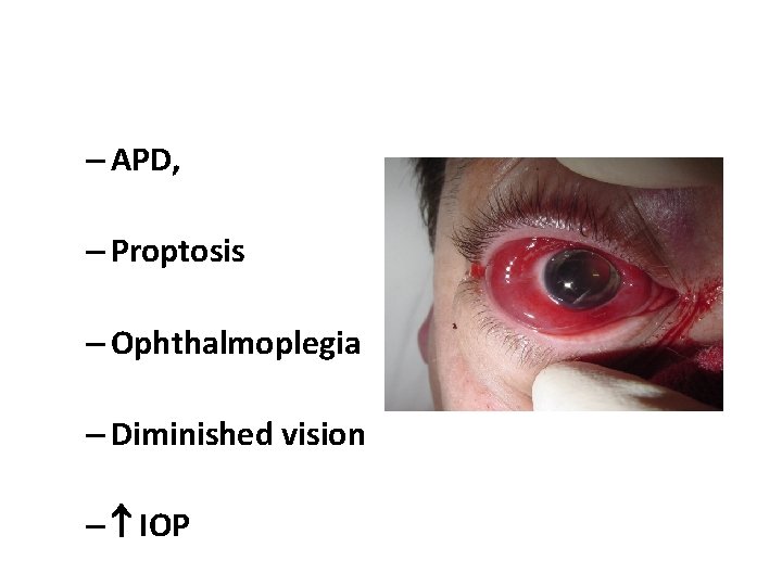 – APD, – Proptosis – Ophthalmoplegia – Diminished vision – IOP 