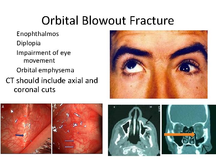 Orbital Blowout Fracture Enophthalmos Diplopia Impairment of eye movement Orbital emphysema CT should include