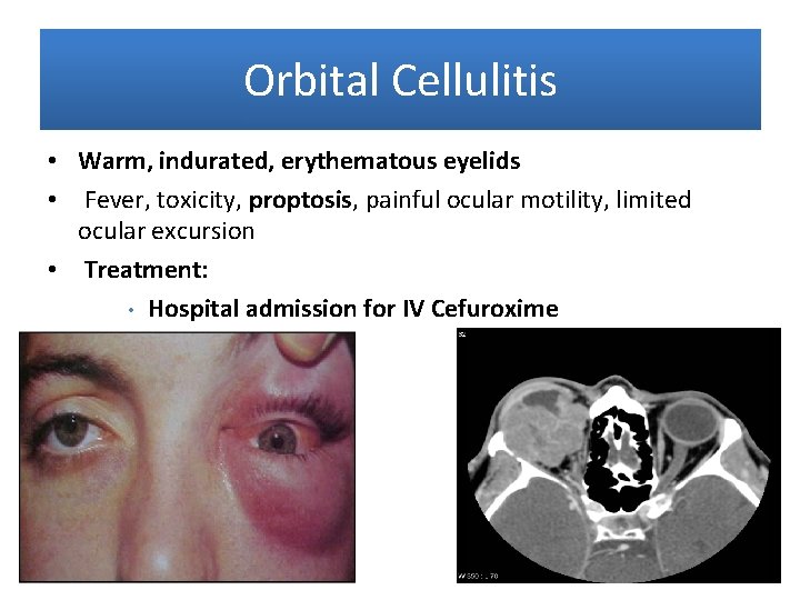 Orbital Cellulitis • Warm, indurated, erythematous eyelids • Fever, toxicity, proptosis, painful ocular motility,