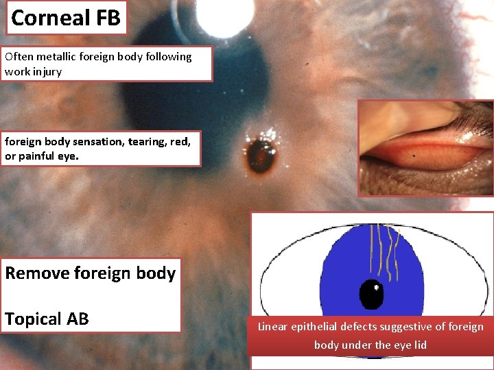 Corneal FB Often metallic foreign body following work injury foreign body sensation, tearing, red,