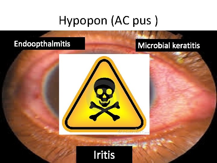 Hypopon (AC pus ) Endoopthalmitis Microbial keratitis Iritis 