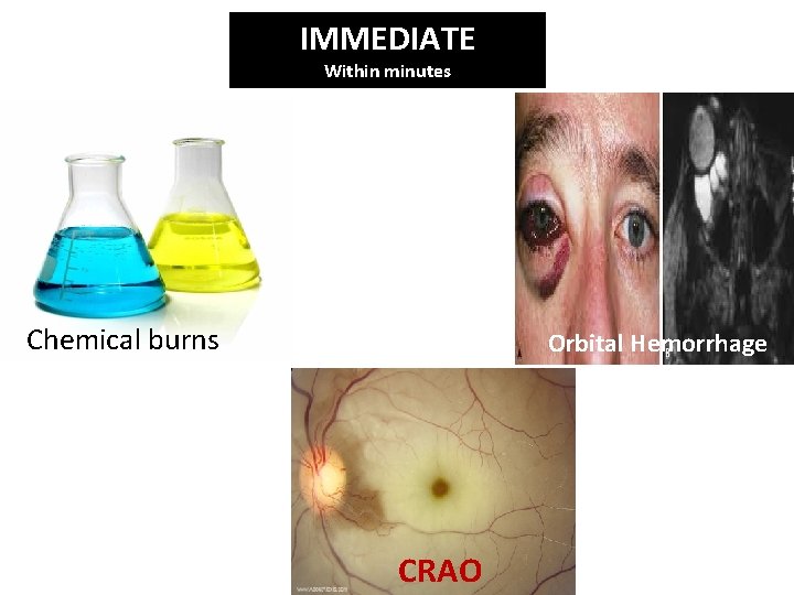 IMMEDIATE Within minutes Chemical burns Orbital Hemorrhage CRAO 