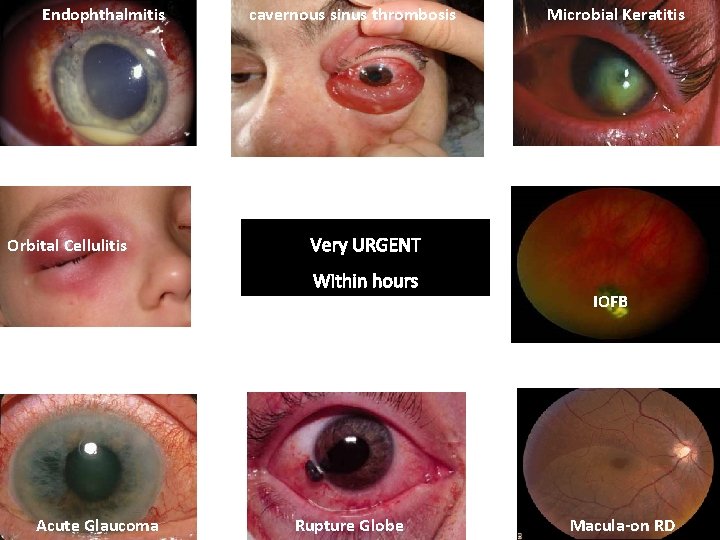 Endophthalmitis Orbital Cellulitis cavernous sinus thrombosis Very URGENT Within hours Acute Glaucoma Microbial Keratitis