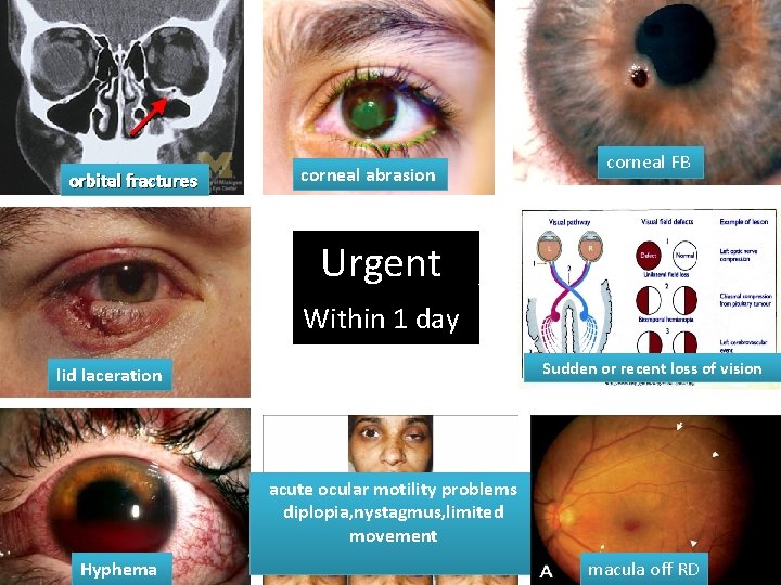 orbital fractures corneal abrasion corneal FB Urgent Within 1 day Sudden or recent loss