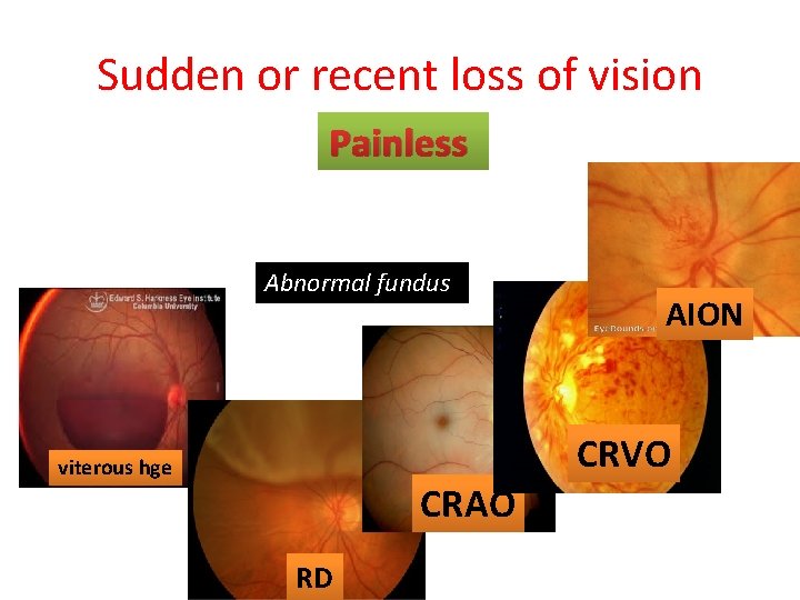 Sudden or recent loss of vision Painless Abnormal fundus AION CRVO viterous hge CRAO