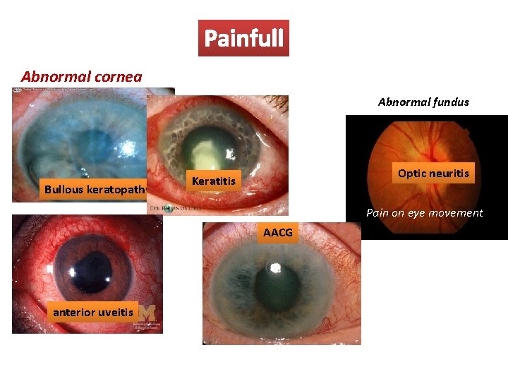 Painfull Abnormal cornea Abnormal fundus Bullous keratopathy Optic neuritis Keratitis Pain on eye movement