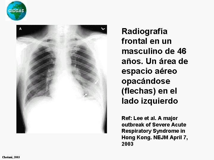 GIDSAS Radiografía frontal en un masculino de 46 años. Un área de espacio aéreo GIDSAS Radiografía frontal en un masculino de 46 años. Un área de espacio aéreo