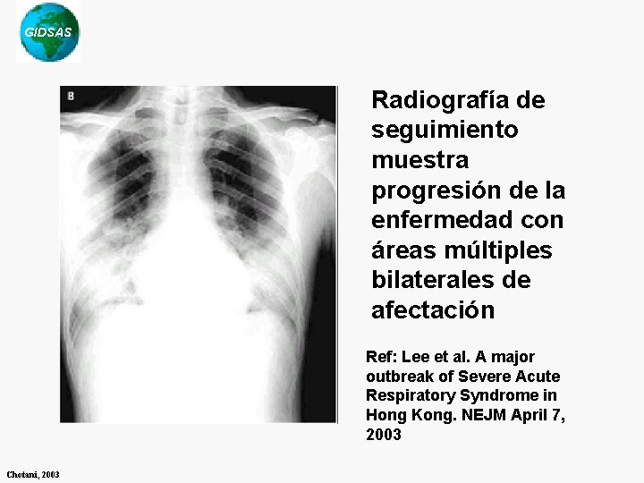 GIDSAS Radiografía de seguimiento muestra progresión de la enfermedad con áreas múltiples bilaterales de GIDSAS Radiografía de seguimiento muestra progresión de la enfermedad con áreas múltiples bilaterales de