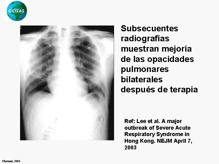 GIDSAS Subsecuentes radiografías muestran mejoría de las opacidades pulmonares bilaterales después de terapia Ref: GIDSAS Subsecuentes radiografías muestran mejoría de las opacidades pulmonares bilaterales después de terapia Ref: