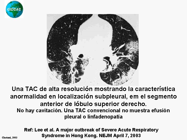 GIDSAS Una TAC de alta resolución mostrando la característica anormalidad en localización subpleural, em GIDSAS Una TAC de alta resolución mostrando la característica anormalidad en localización subpleural, em
