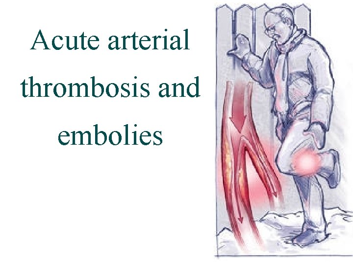 Acute arterial thrombosis and embolies 