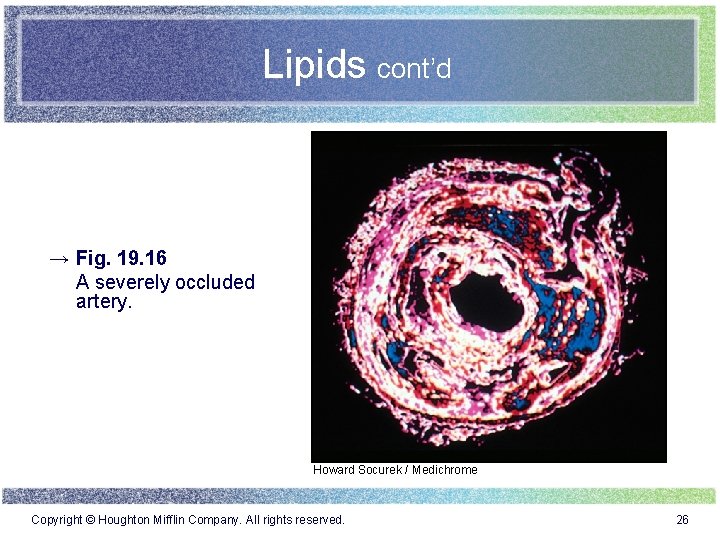 Lipids cont’d → Fig. 19. 16 A severely occluded artery. Howard Socurek / Medichrome