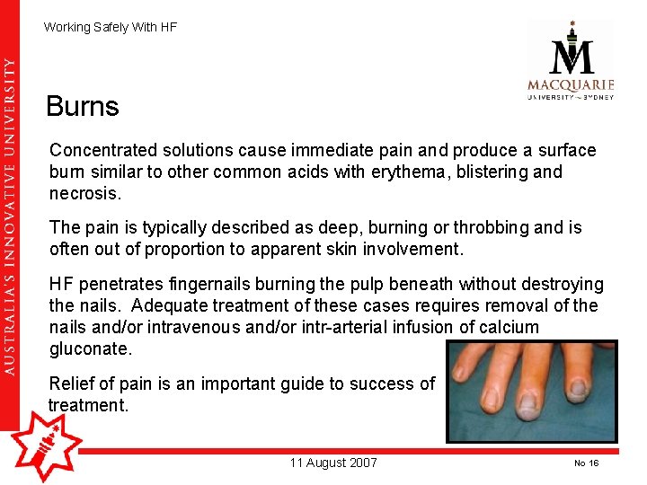 Working Safely With HF Burns Concentrated solutions cause immediate pain and produce a surface Working Safely With HF Burns Concentrated solutions cause immediate pain and produce a surface