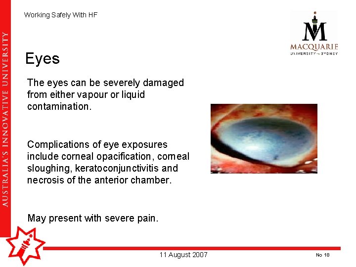 Working Safely With HF Eyes The eyes can be severely damaged from either vapour Working Safely With HF Eyes The eyes can be severely damaged from either vapour