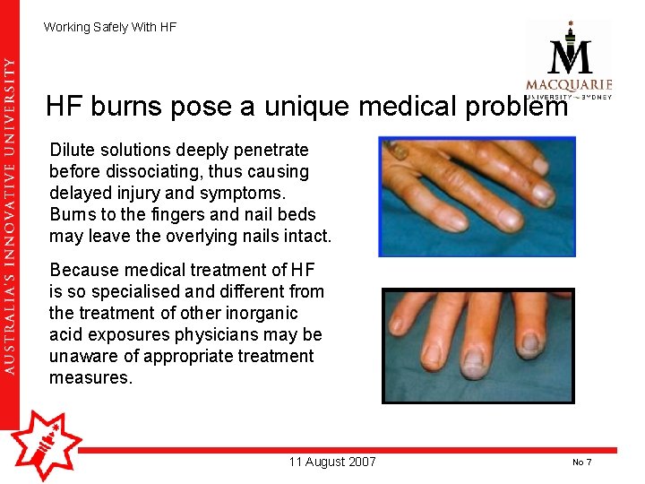 Working Safely With HF HF burns pose a unique medical problem Dilute solutions deeply Working Safely With HF HF burns pose a unique medical problem Dilute solutions deeply