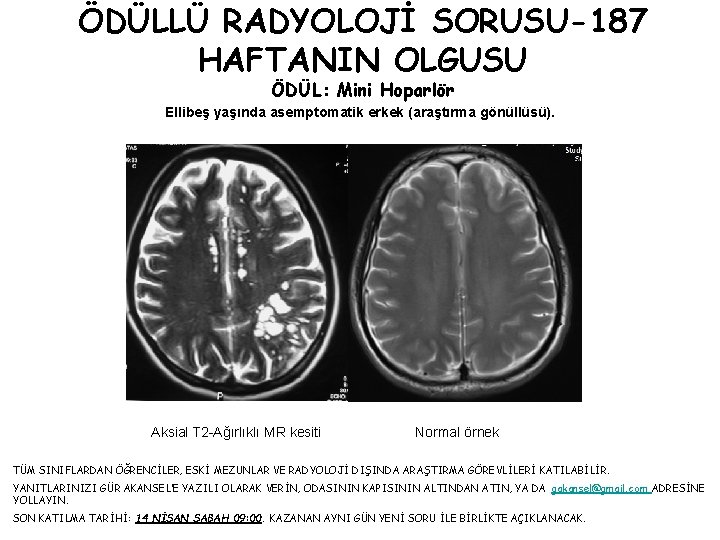 ÖDÜLLÜ RADYOLOJİ SORUSU-187 HAFTANIN OLGUSU ÖDÜL: Mini Hoparlör Ellibeş yaşında asemptomatik erkek (araştırma gönüllüsü).