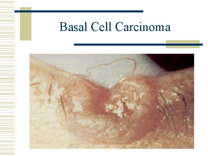 Basal Cell Carcinoma 