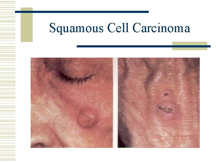 Squamous Cell Carcinoma 