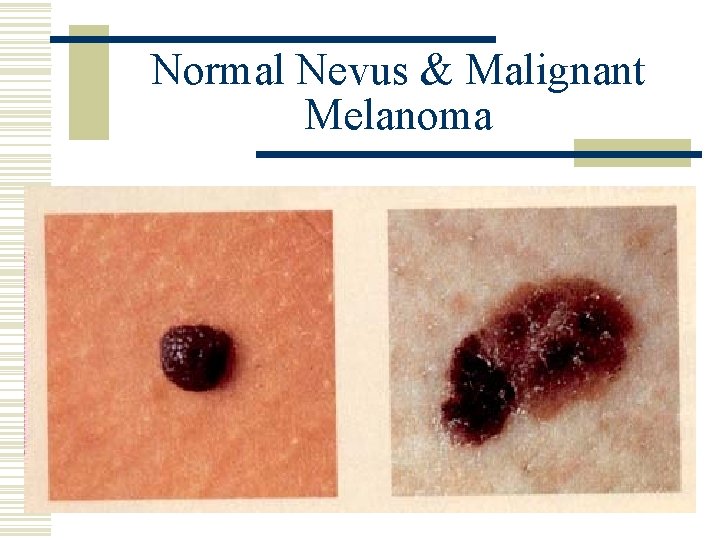 Normal Nevus & Malignant Melanoma 