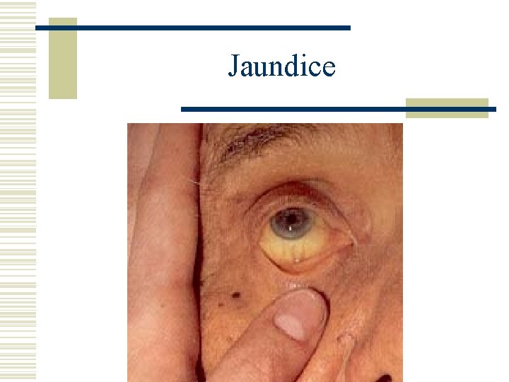 Jaundice 