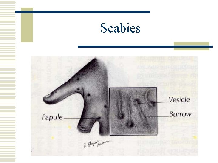 Scabies 