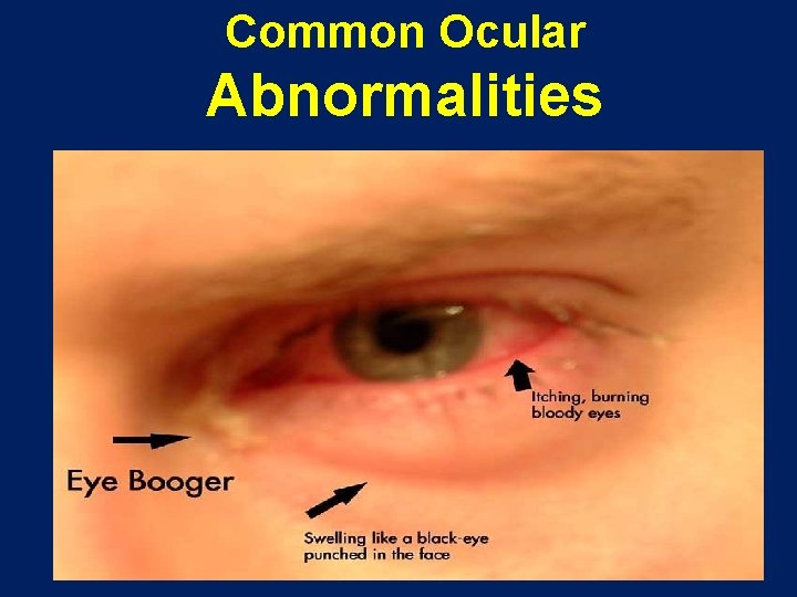 Common Ocular Abnormalities 