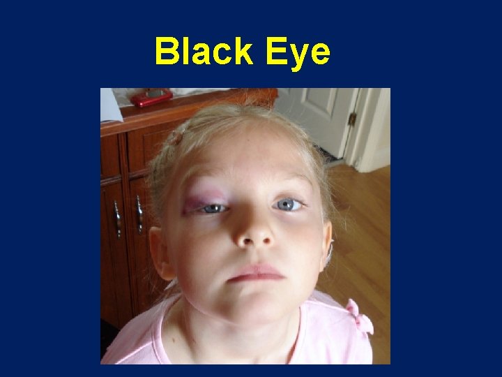 Black Eye 