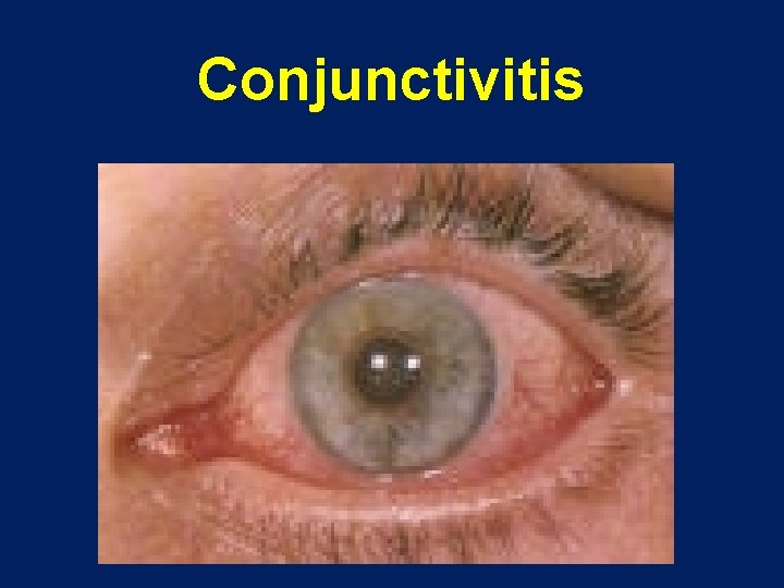 Conjunctivitis 