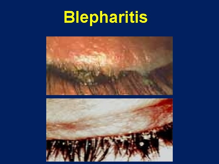  Blepharitis 