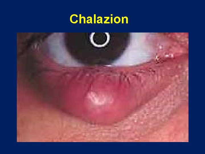 Chalazion 