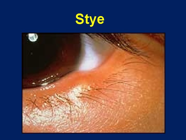 Stye 