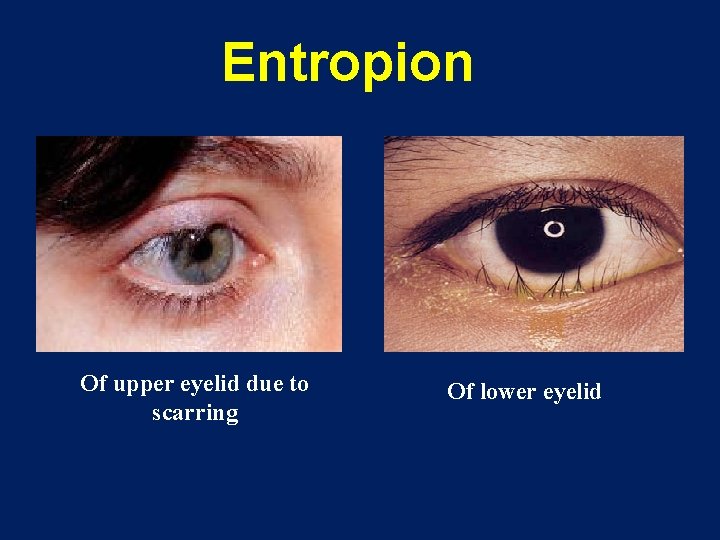 Entropion Of upper eyelid due to scarring Of lower eyelid 