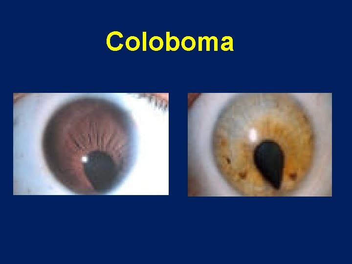 Coloboma 