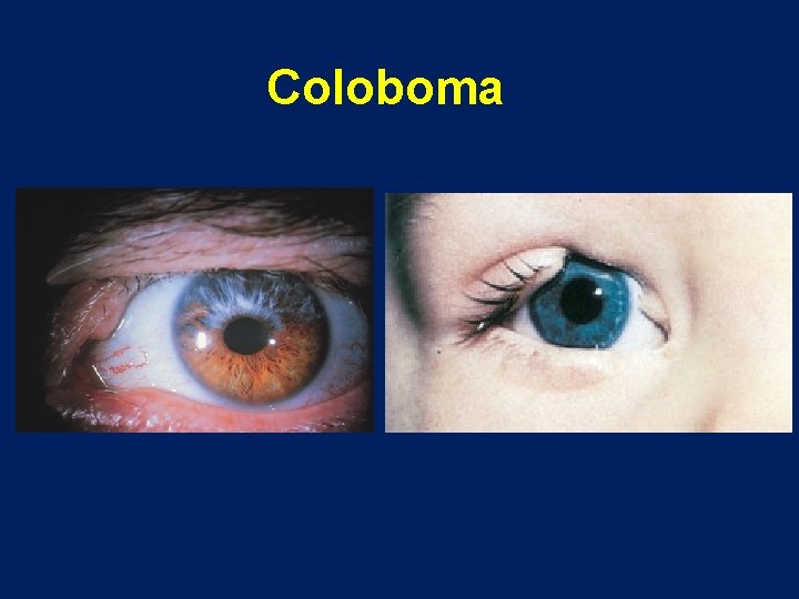 Coloboma 