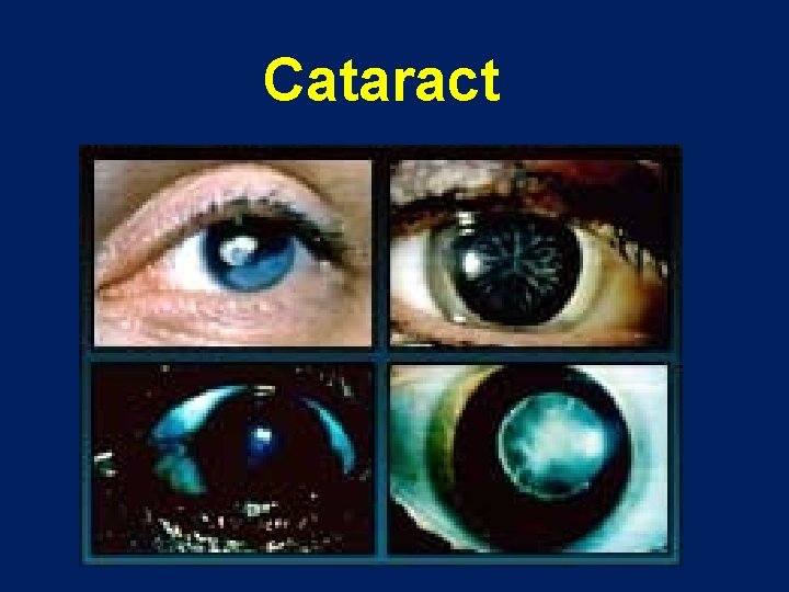 Cataract 