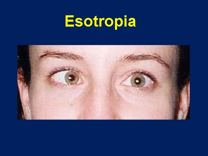 Esotropia 