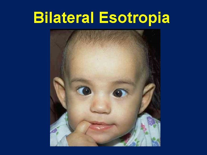 Bilateral Esotropia 