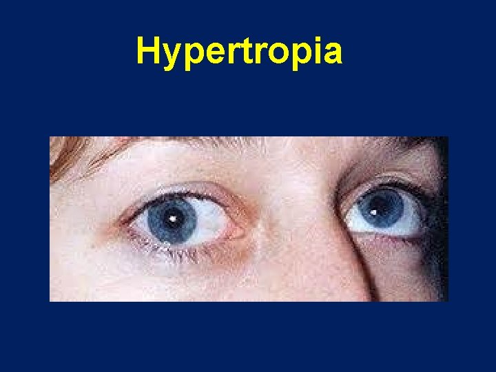 Hypertropia 