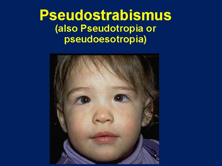 Pseudostrabismus (also Pseudotropia or pseudoesotropia) 