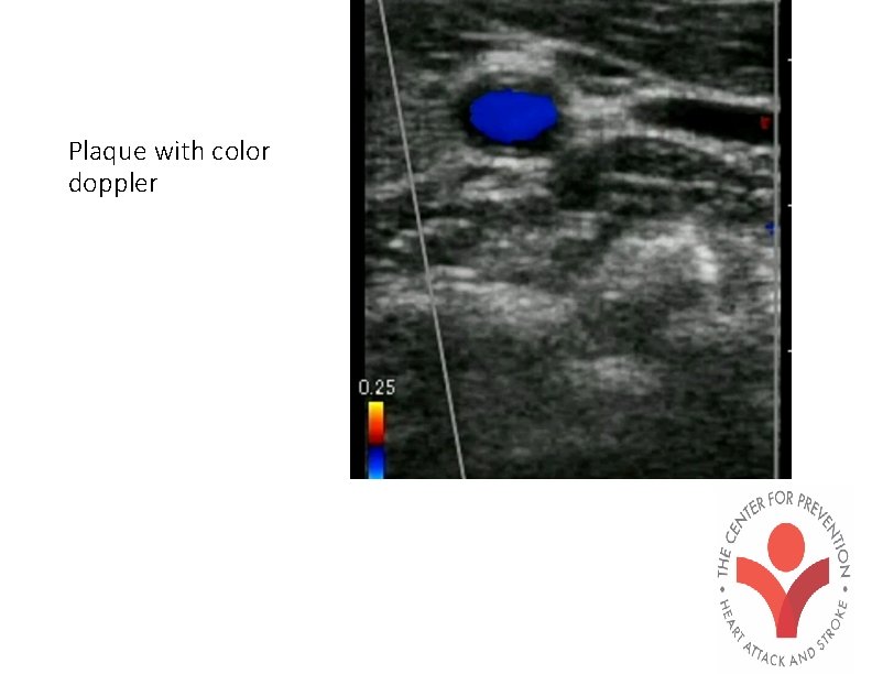 Plaque with color doppler 