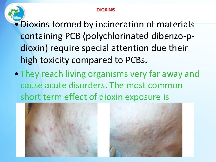 DIOXINS… • Dioxins formed by incineration of materials containing PCB (polychlorinated dibenzo-pdioxin) require special